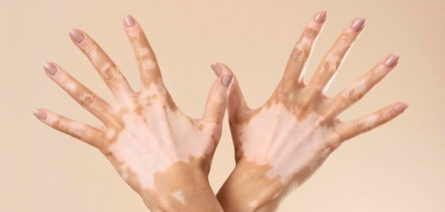 Opzelura The first drug to restore pigmentation for vitiligo patients